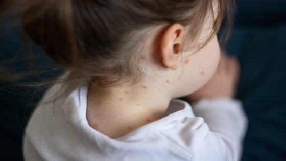 وفاة طفل ثان.. مرض مرتبط بالحصبة يتفشى في تكساس الأمريكية “صدى الخبر”