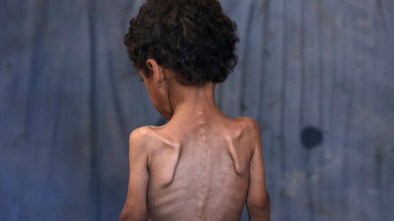 المجاعة تفتك بأجساد الأطفال في غزة وسط نقص مستمر بوصول المساعدات “صدى الخبر”